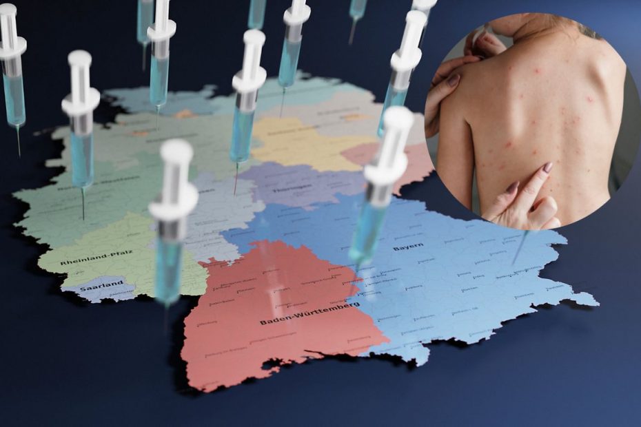 RKI: Pierwsze dziecko w Niemczech zakażone małpią ospą