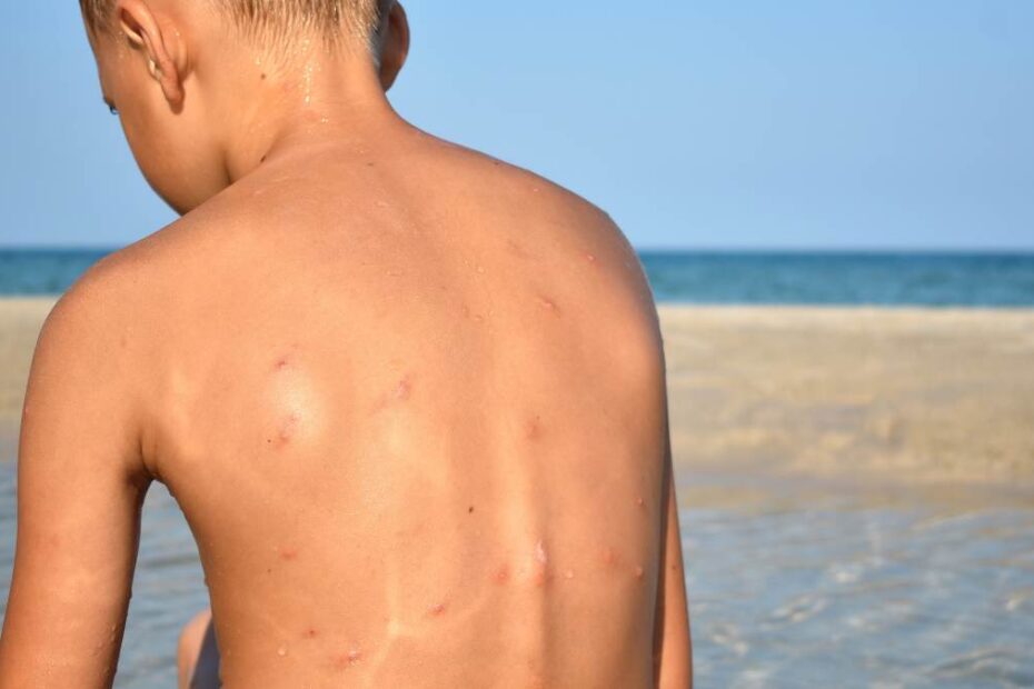 Brutalna plaga nad Bałtykiem foto: dziecko z pogryzionymi przez komary plecami